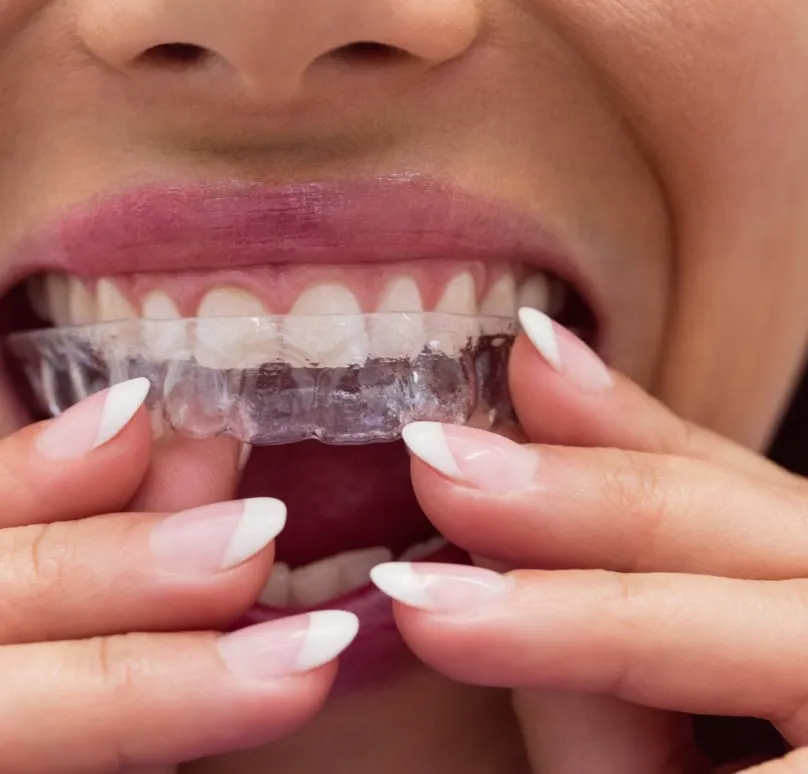 Invisalign Teeth Straightening